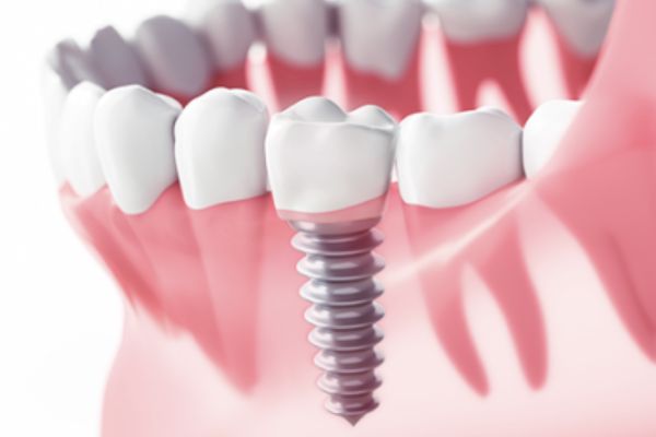 Implanturi dentare – Megagen, Nobel, Straumann